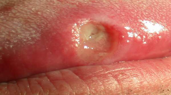 Picture of Mouth Ulcers
