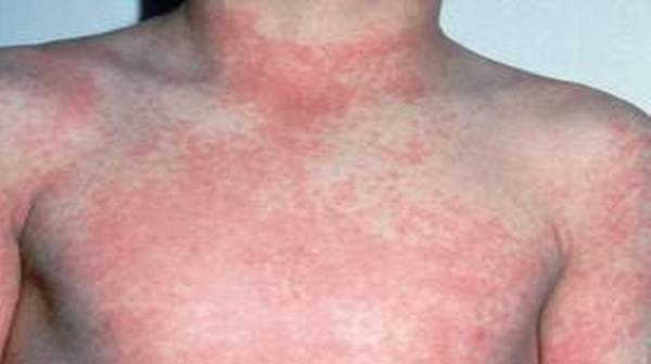 Rash From Strep Throat Pictures 30
