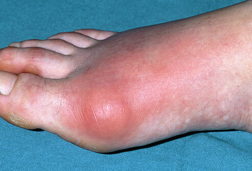 Gout or Arthritis
