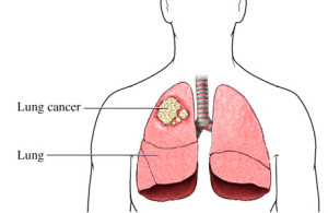 cancer, skin cancer, melanoma, breast cancer, lung cancer, ovarian cancer, prostate cancer, pancreatic cancer, colon cancer, cancer symptoms, cancer treatment, cancer information, chemotherapy, carcinoma, malignancy, tumor, oncology