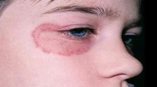 can i take diflucan for ringworm