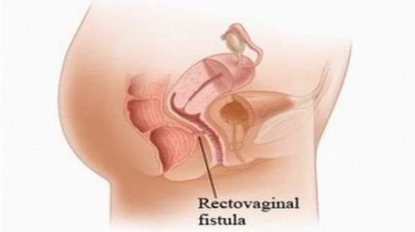 An obstetric fistula is a hole between the vagina and rectum or bladder that is caused by prolonged obstructed labor, leaving a woman incontinent of urine or feces or both.