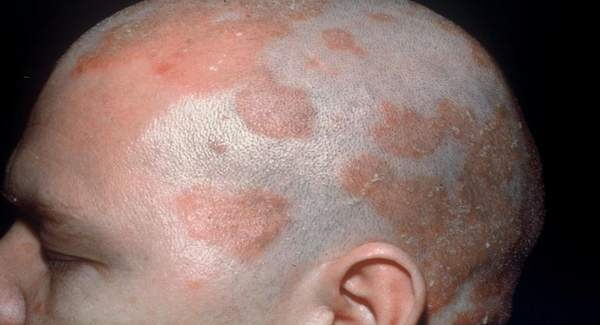 Risk of Developing Seborrheic Eczema