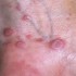 Lichen Planus, Risk for Lichen Planus, Treating Lichen Planus, Causes of Lichen Planus, Symptoms of Lichen Planus