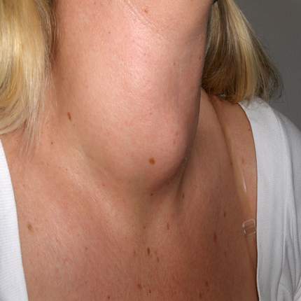 Goiter: occur without a known reason
