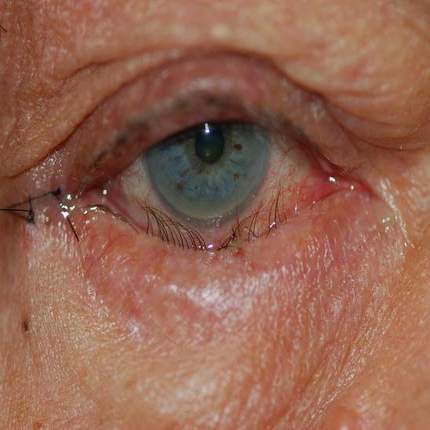 Entropion: eyelid commonly affected