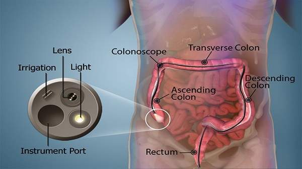 side effects from colonoscopy