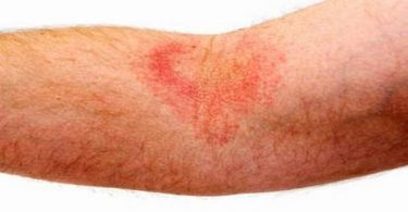 Eczema is "a general term for any superficial inflammatory process involving the epidermis primarily, marked early by redness and itching.