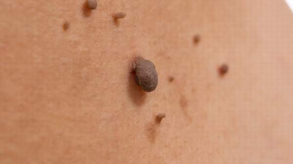 Moles are a member of the family of skin lesions known as nevi.