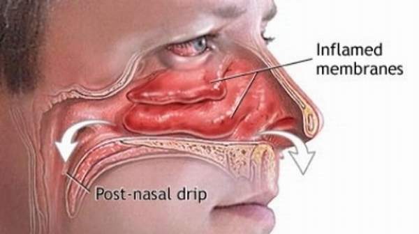 post nasal drip symptoms